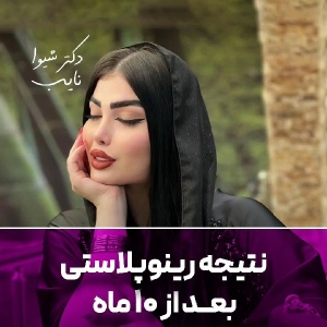 rhinoplasty-2