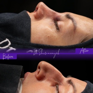 rhinoplasty-4
