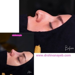 rhinoplasty-5