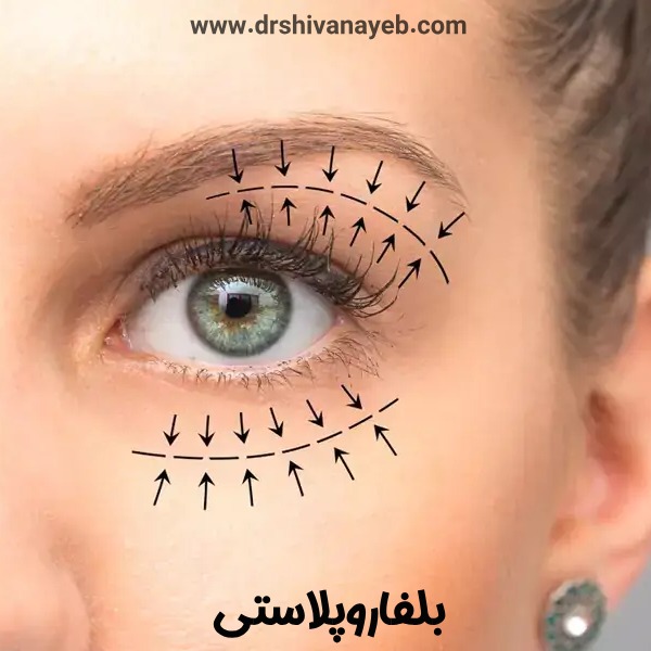 بلفاروپلاستی 