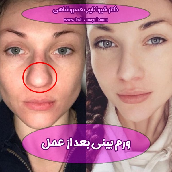 ورم بینی بعد از عمل