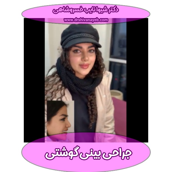 عکس جراحی بینی گوشتی