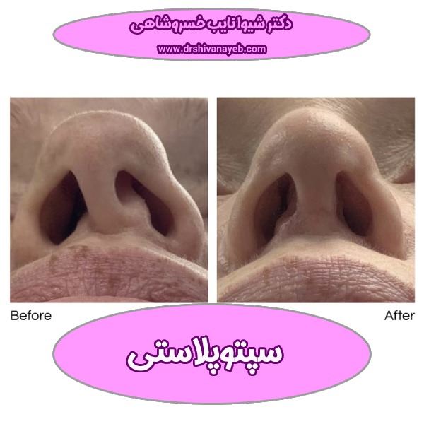 سپتوپلاستی 