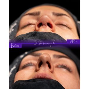 نمونه کار جراحی بینی استخوانی