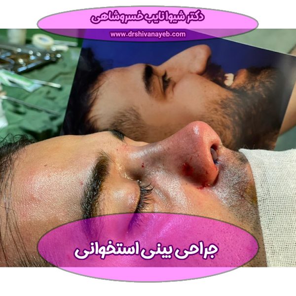 جراحی بینی استخوانی