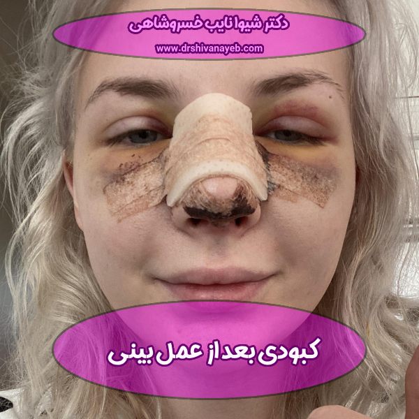 کبودی بعد از عمل بینی
