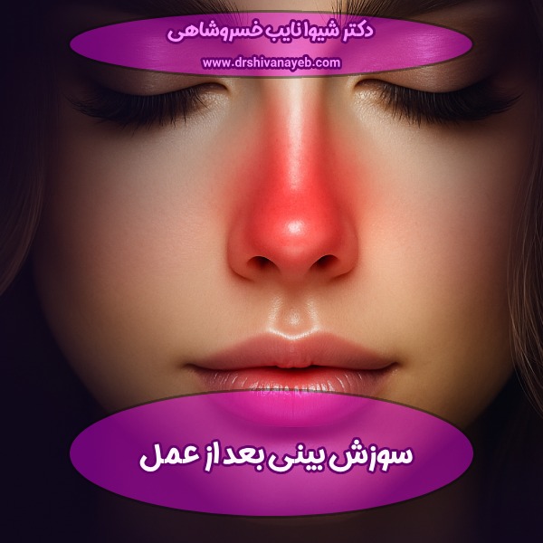 سوزش بینی بعد از عمل