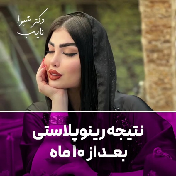 عکس نمونه کار بهترین جراح بینی تبریز