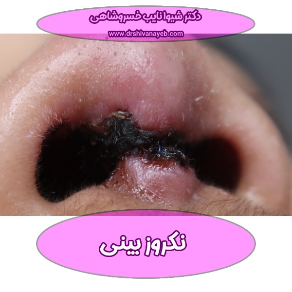 نکروز بینی