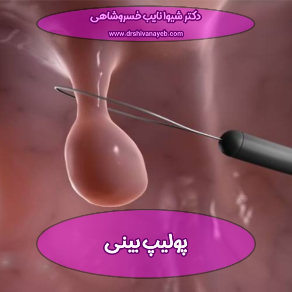 پولیپ بینی