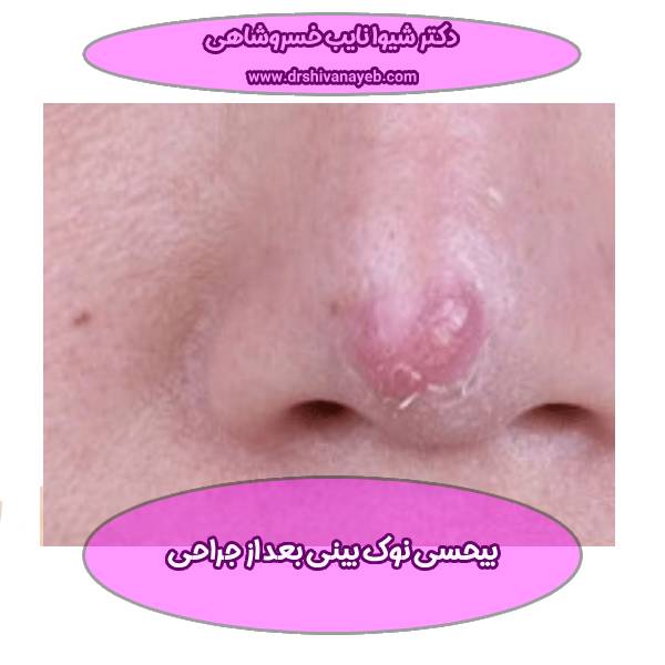 بیحسی نوک بینی بعد از جراحی