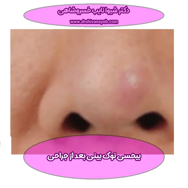 بیحسی نوک بینی بعد از جراحی