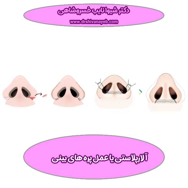 آلارپلاستی