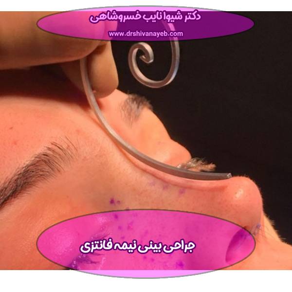 جراحی بینی نیمه فانتزی