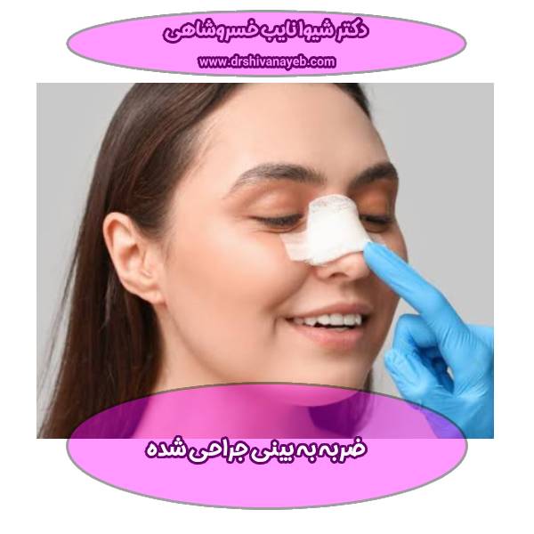 ضربه به بینی جراحی شده