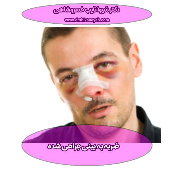 ضربه به بینی جراحی شده
