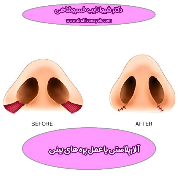 آلارپلاستی