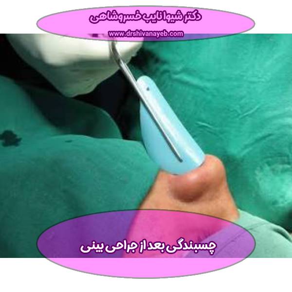درمان چسبندگی بینی بعد از جراحی