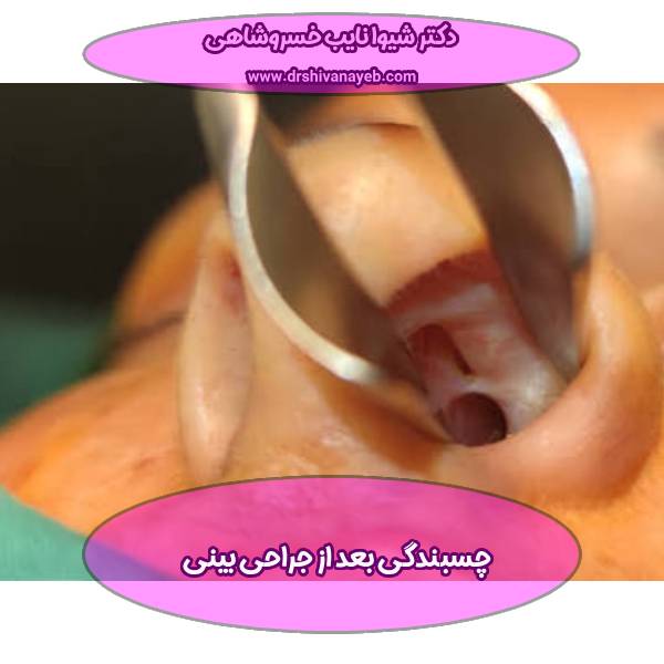 چسبندگی بینی بعد از جراحی