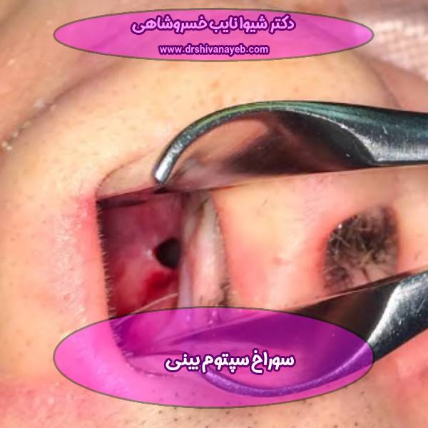 سوراخ شدن تیغه بینی