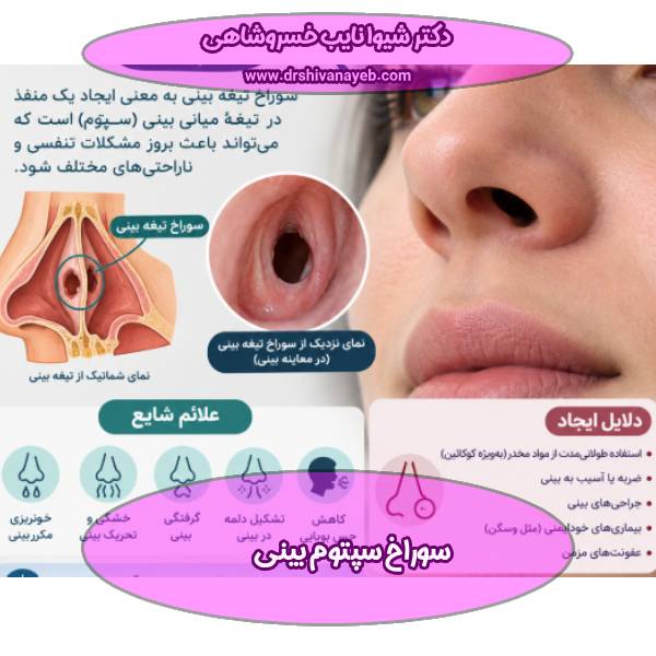سوراخ سپتوم بینی