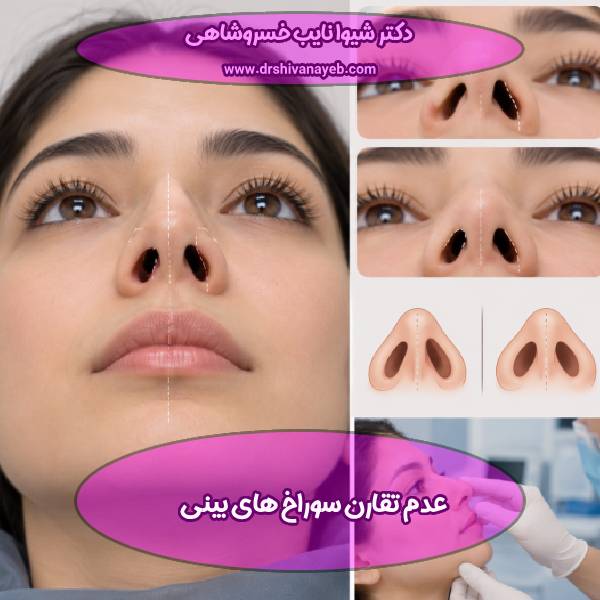 عدم تقارن سوراخ های بینی پس از جراحی بینی