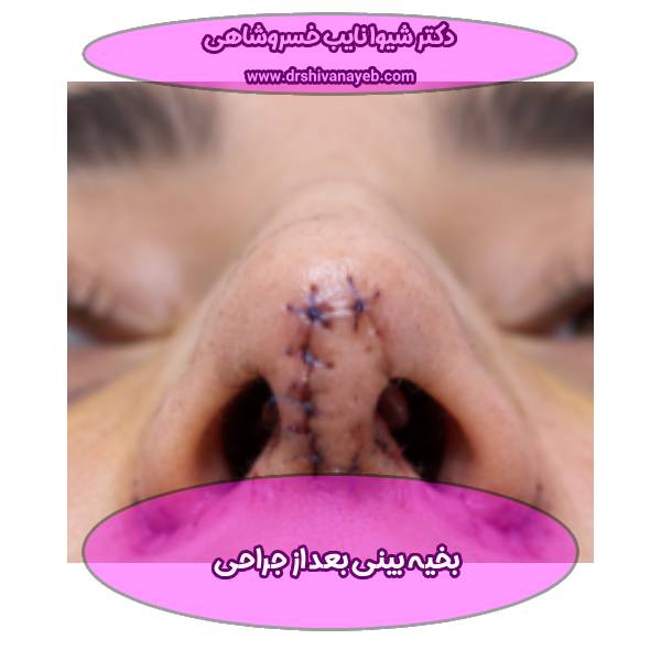 بخیه بعد از جراحی بینی
